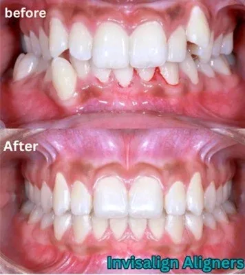 Image showing Before and after images of patient