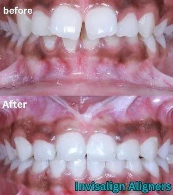 Image capturing post treatment changes 