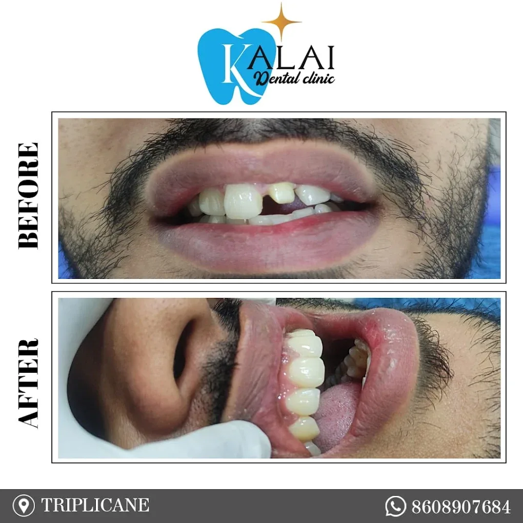 Image showing a broken tooth replaced