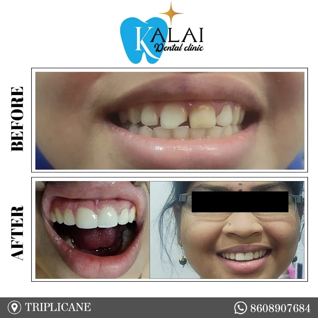 Image showing broken teeth corrected and patient smiling