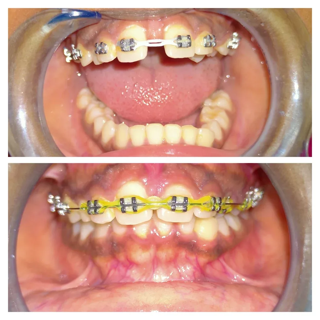 patient braces before and after images