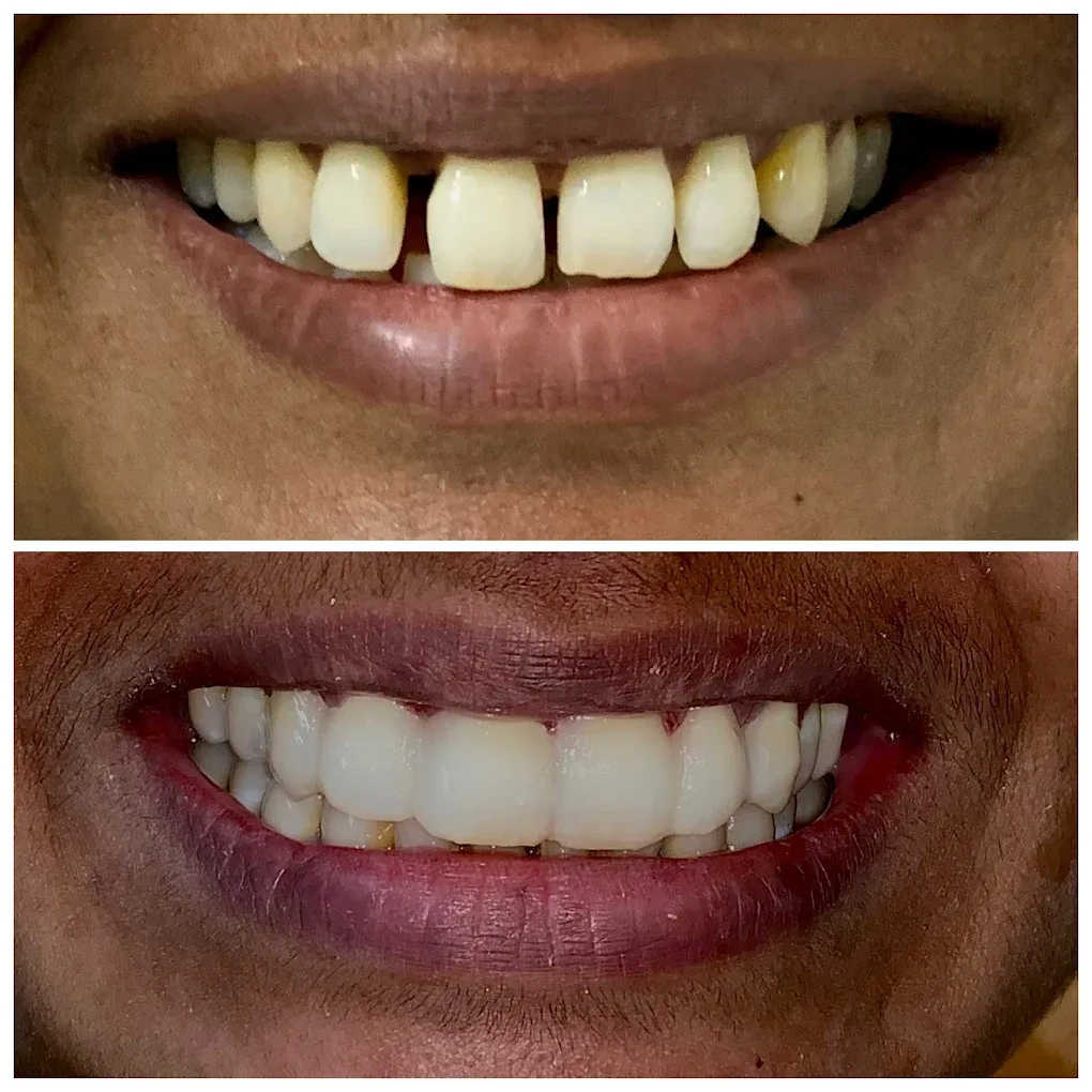happy patient teeth images