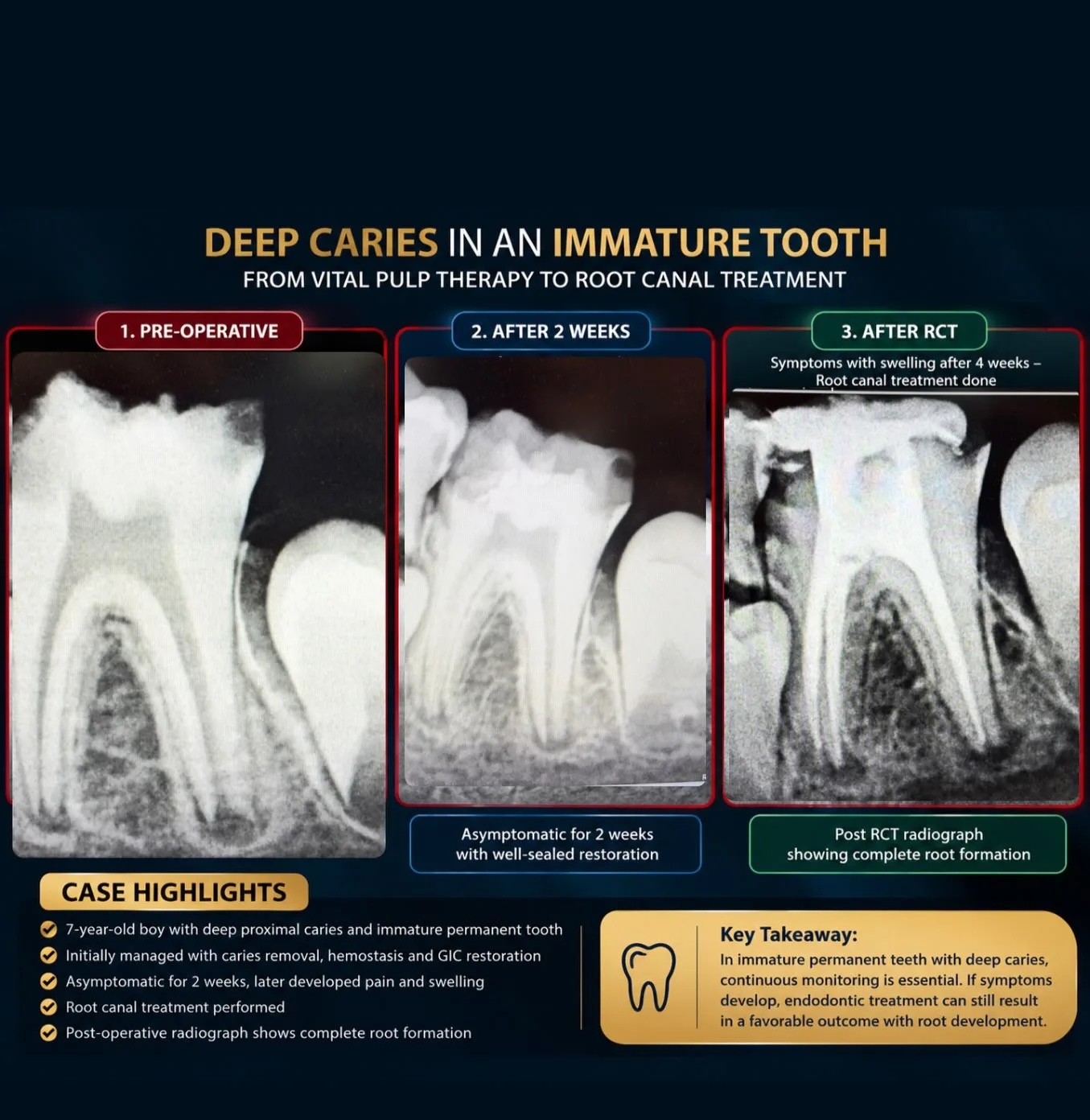 Endodontic retreatment case